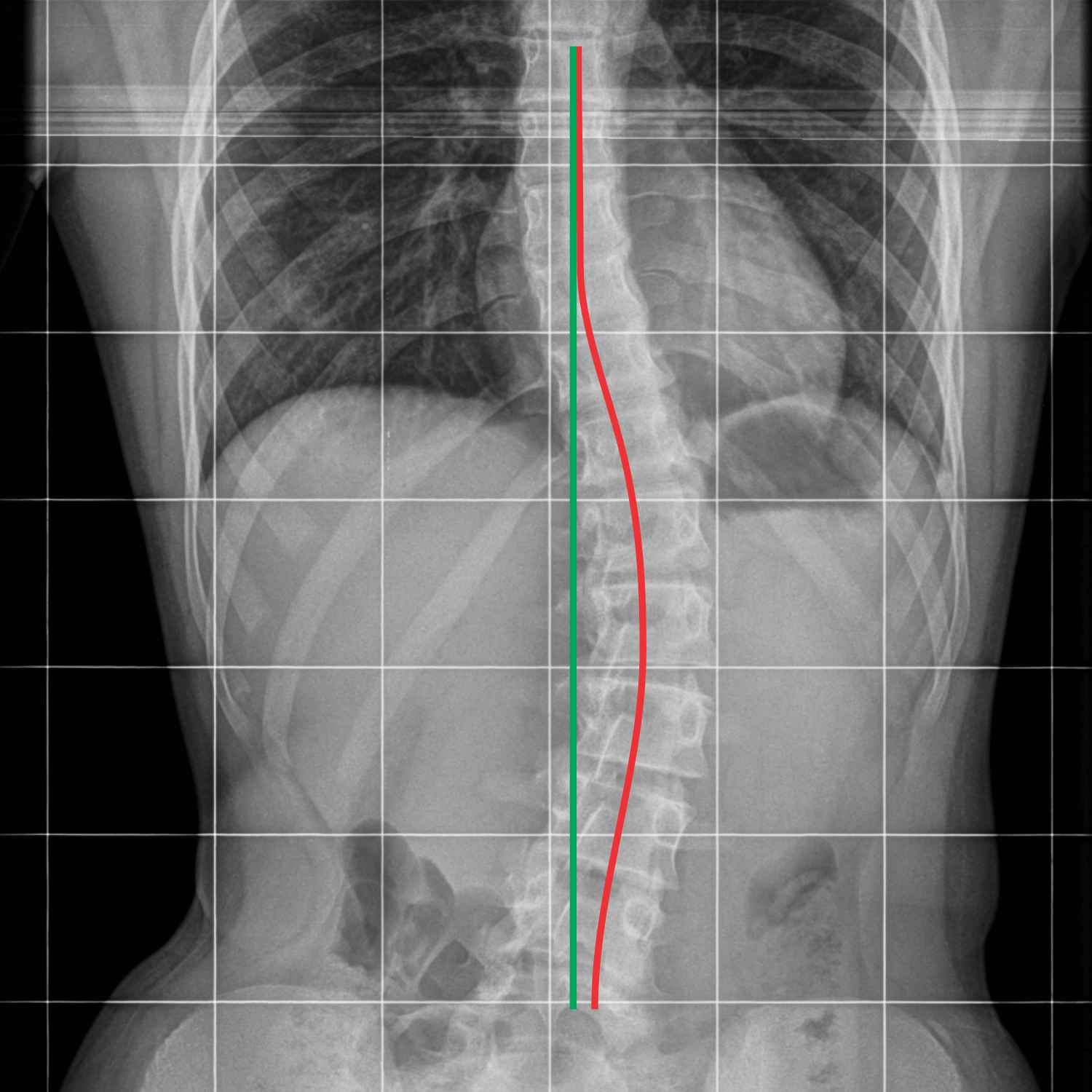 MRI ukrivljenost hrbtenice, skolioza, skolioza vaje, simptomi, zdravljenje